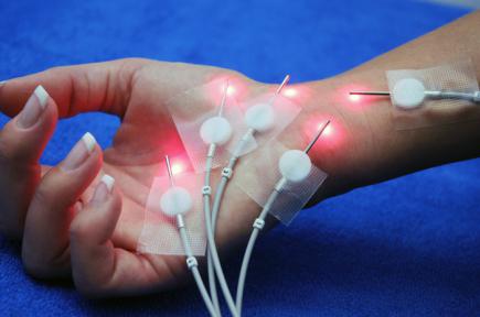 Hand - Laserakupunktur